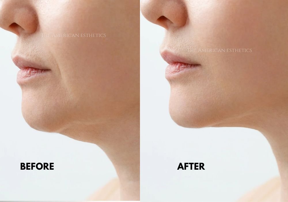 skin lifting treatment