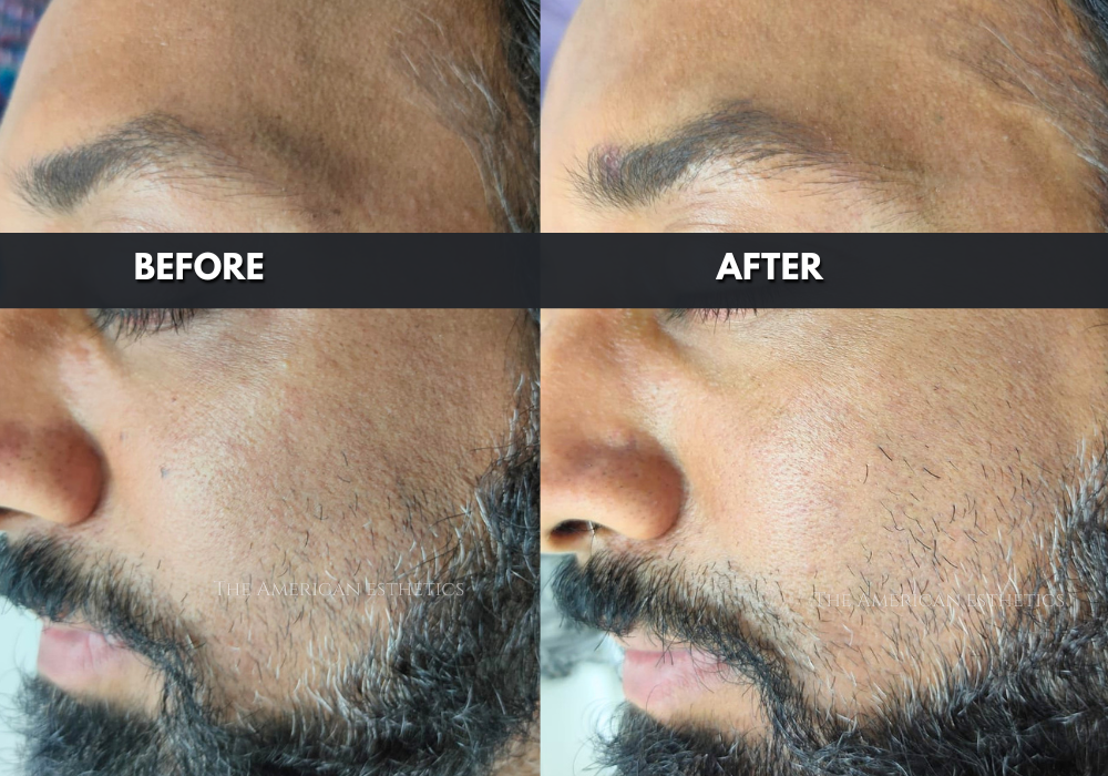 CARBON PEEL TREATMENT