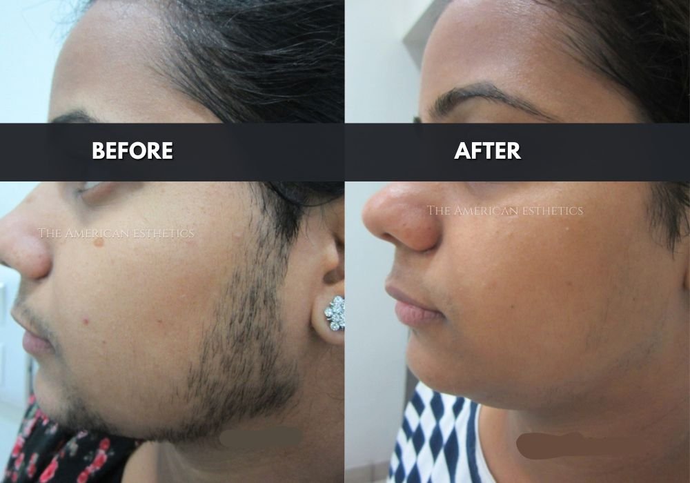 face hair removal