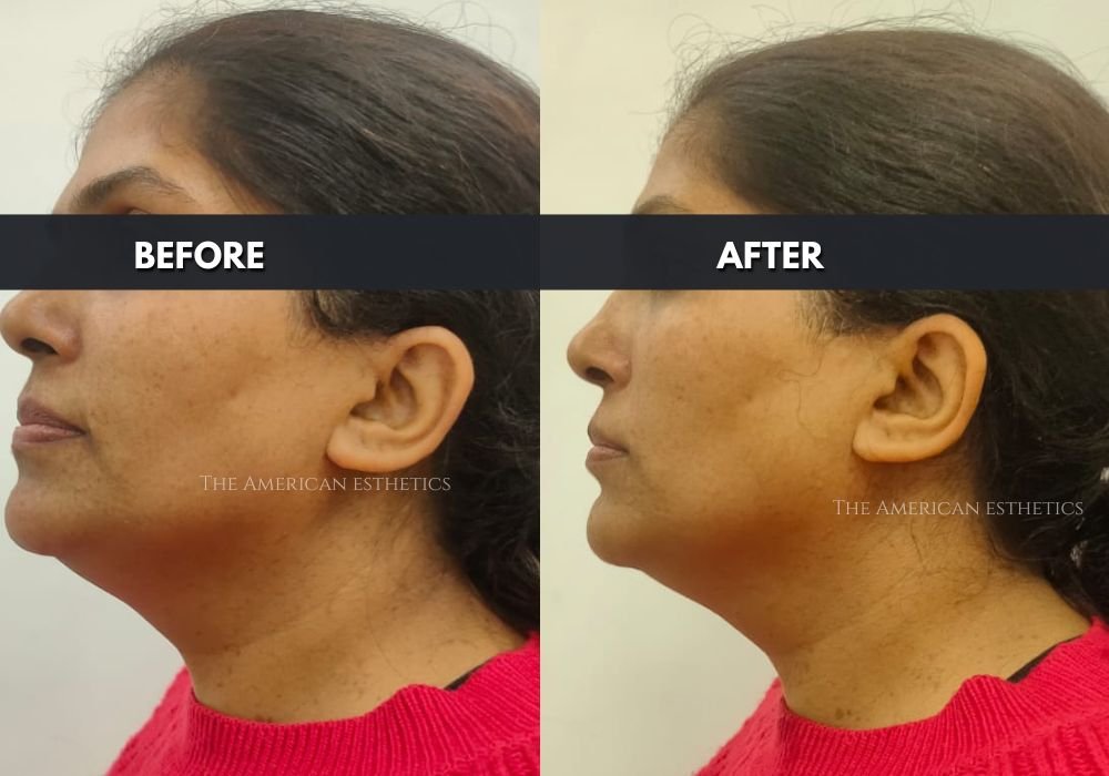 double chin treatment in ludhiana