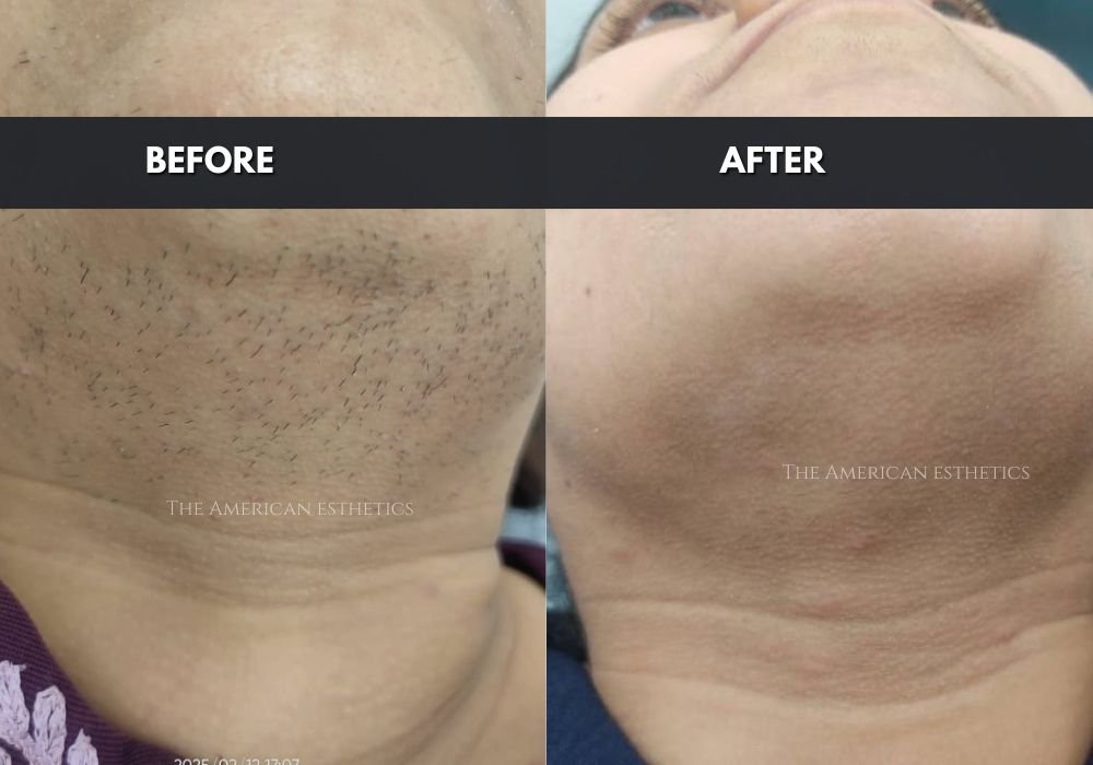 face hair removal
