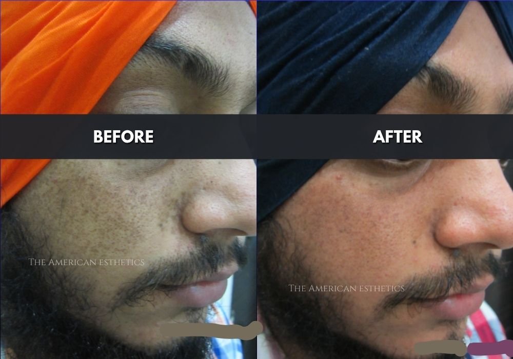 pigmentation treatment in ludhiana