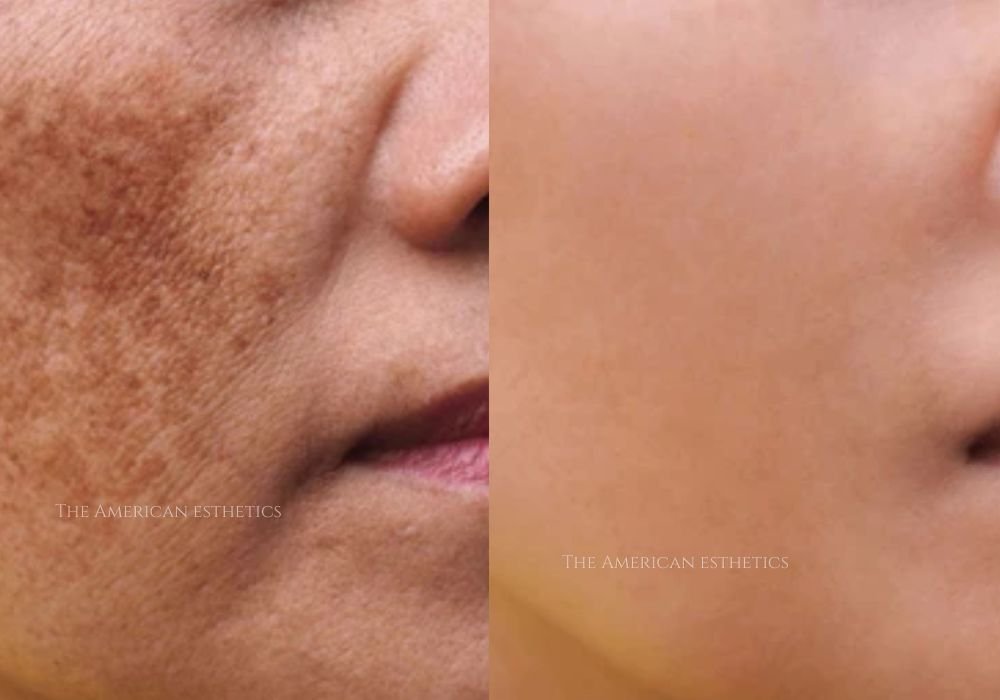pigmentation treatment in ludhiana