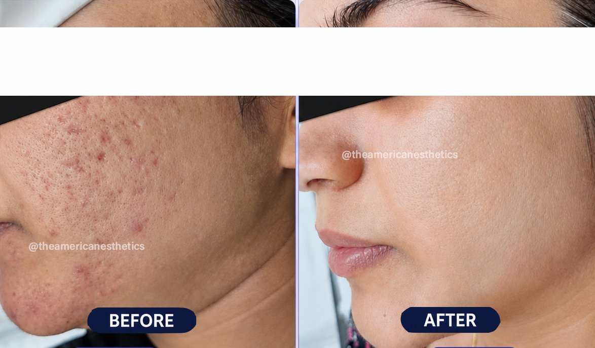 acne scar treatment in ludhiana
