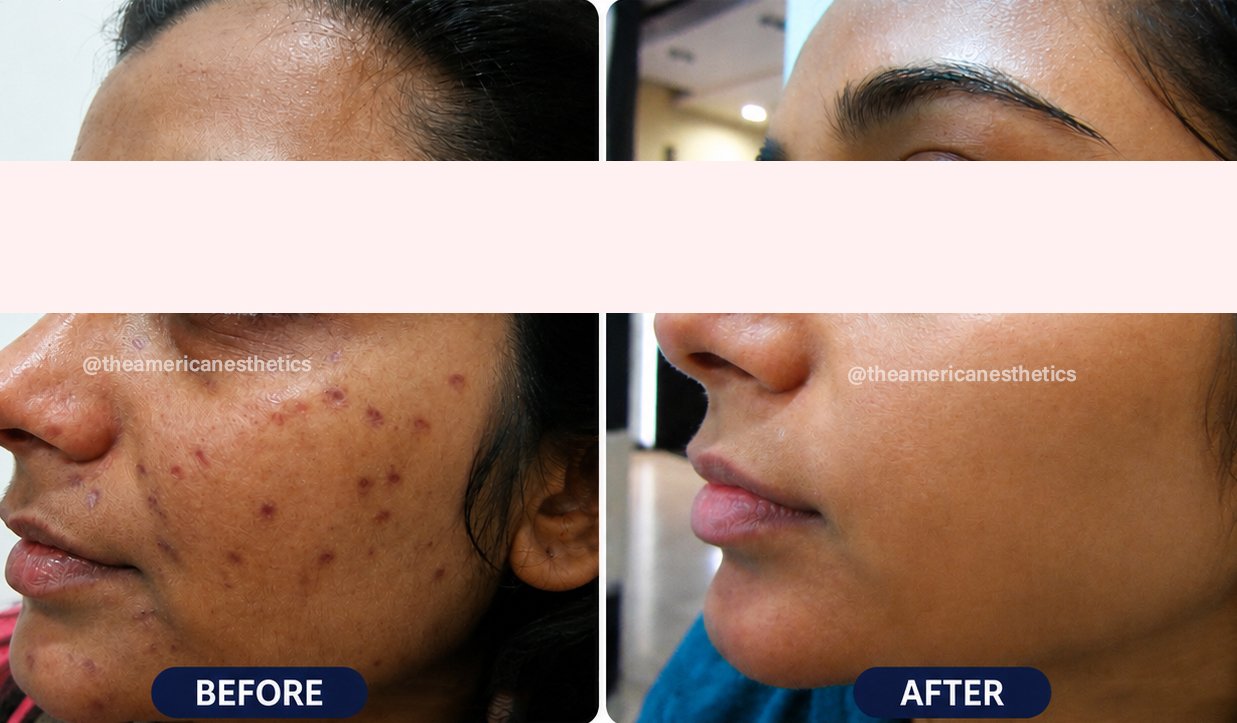 chicken pox scar treatment in ludhiana